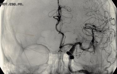 Fluoroscopy of the skull