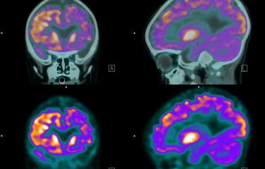 Nuclear medicine scan of skull using positron emission tomography