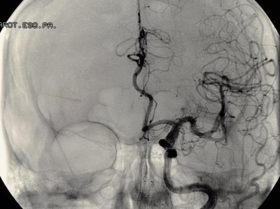 Fluoroscopy of the skull
